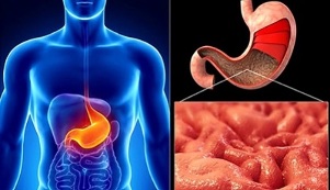 Rules of eating gastritis